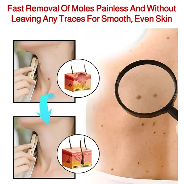 Patch Wart Flesh Mole Acne Patch Beauty Skin Care No Pain Easy To Operate