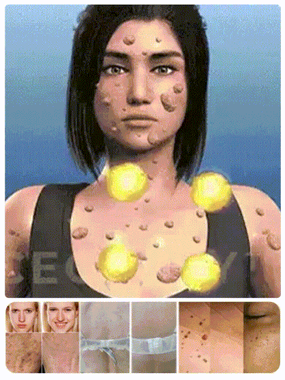 "One-Second Wart Removal" Wart Shedding Cream