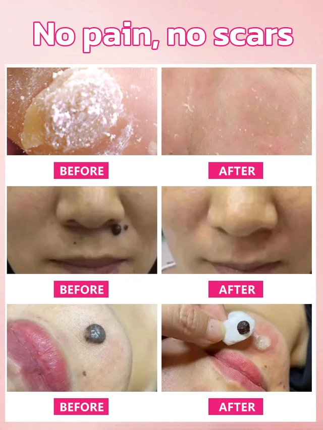 Herbal wart and corn removal cream