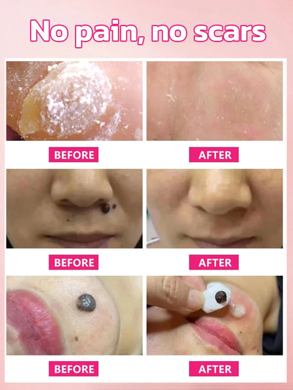 Herbal wart and corn removal cream