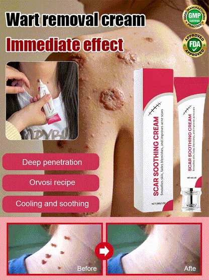 "One-Second Wart Removal" Wart Shedding Cream