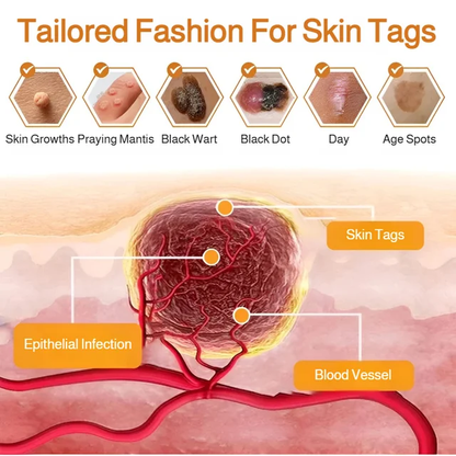 Patch Wart Flesh Mole Acne Patch Beauty Skin Care No Pain Easy To Operate