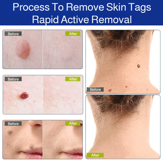 Patch Wart Flesh Mole Acne Patch Beauty Skin Care No Pain Easy To Operate