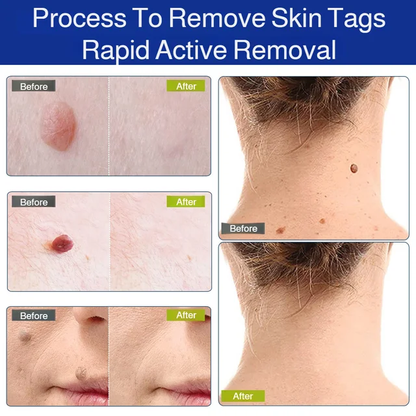 Patch Wart Flesh Mole Acne Patch Beauty Skin Care No Pain Easy To Operate