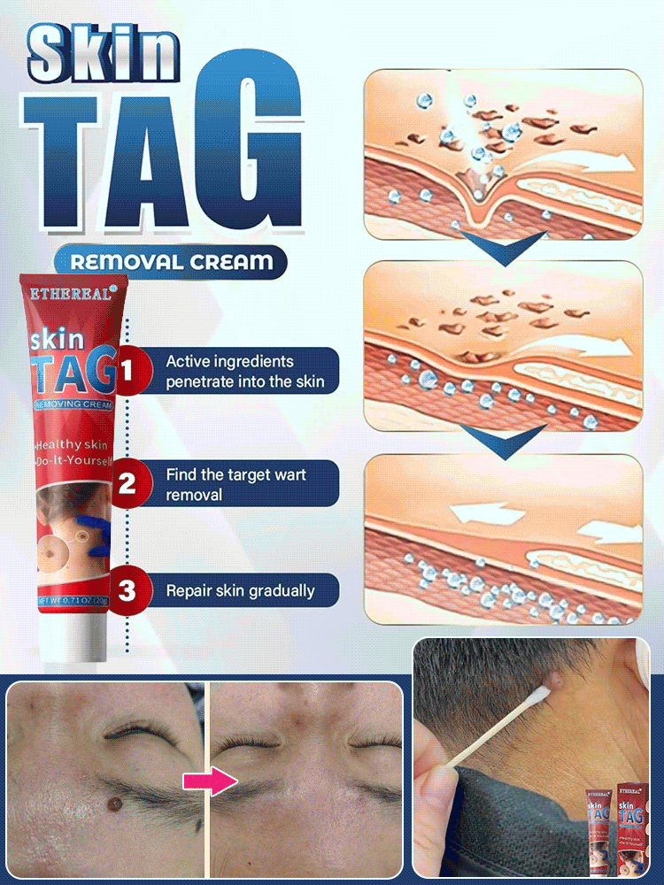 Herbal wart and corn removal cream