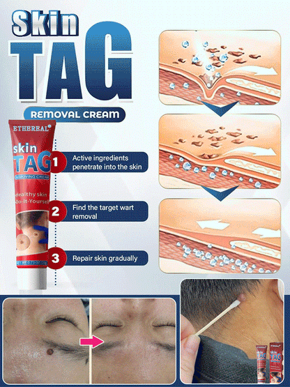 Herbal wart and corn removal cream