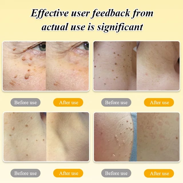 BOOMOON Bee Venom  Treatment Spray