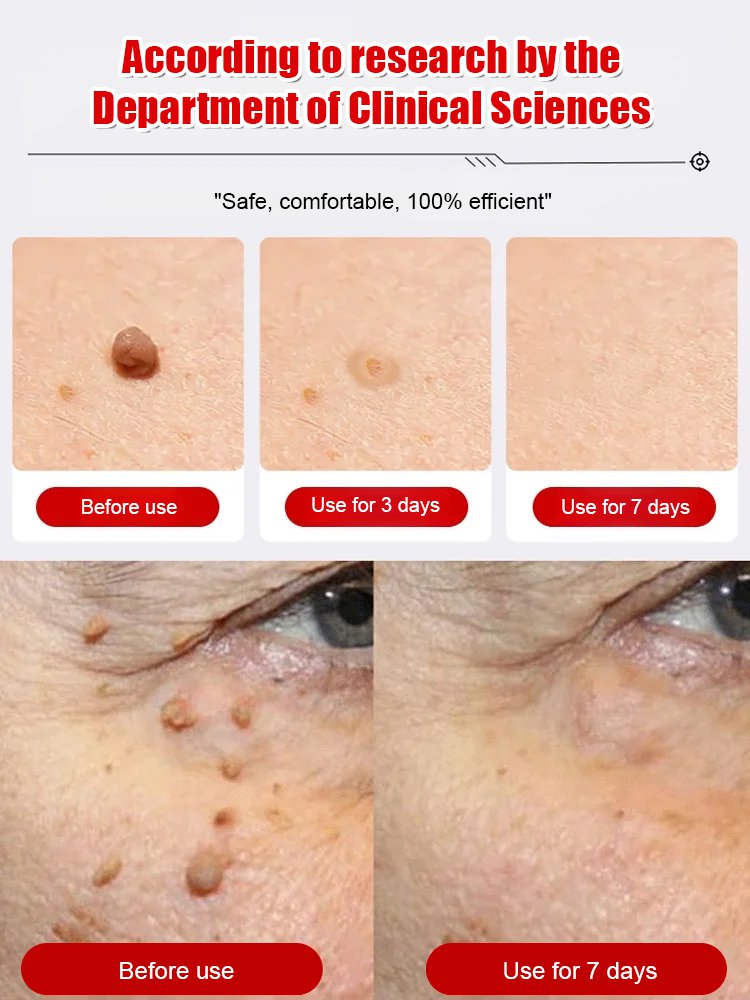 "One-Second Wart Removal" Wart Shedding Cream