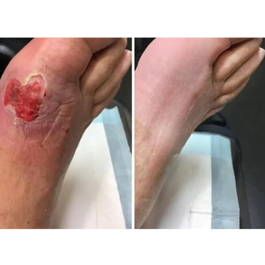 Diabetics Skin Relief cream