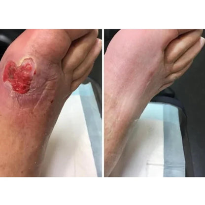 Diabetics Skin Relief cream