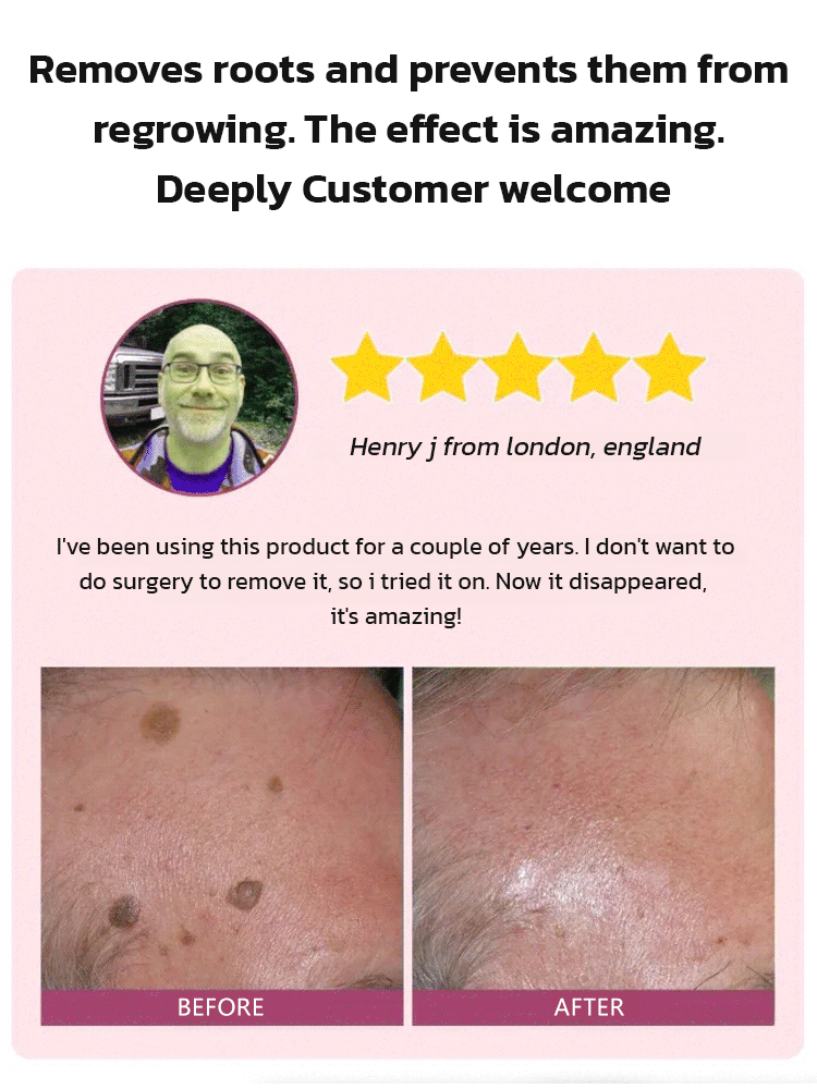 Herbal wart and corn removal cream