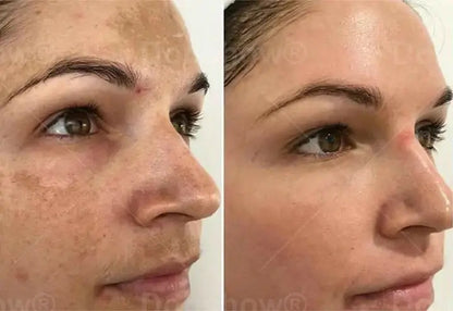 Melantrax Anti-Hyperpigmentation Essence