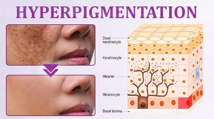 Melantrax Anti-Hyperpigmentation Essence
