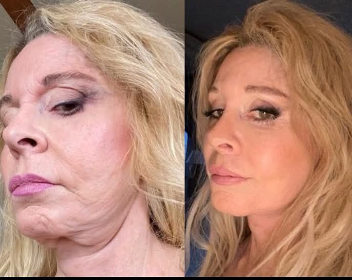 🐝🌿Ringmiz Botox BeeVenom Firming SerumStick-(Made and shippedfrom Australia)-LASTDAY 70% OFF